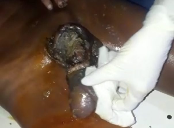 Extremely severe penis disease leaves it covered worms.