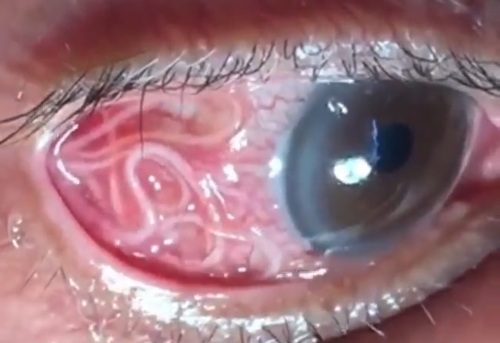 Worms infection in the eye.