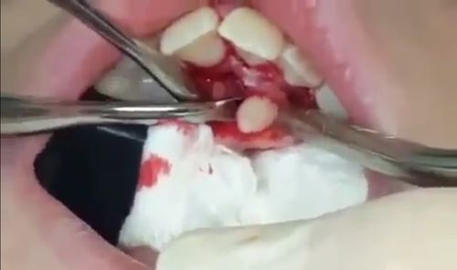 Removing tooth from the roof of the mouth.