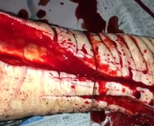 Arm completely open with a kitchen knife in a self-mutilation session.