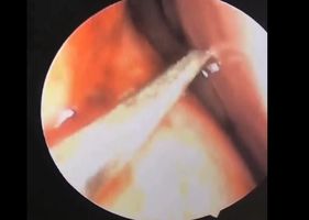Doctor removing live leech from a patient’s nose.