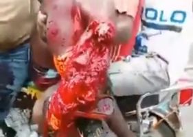 Legs completely destroyed in a motorcycle accident in Cameroon.