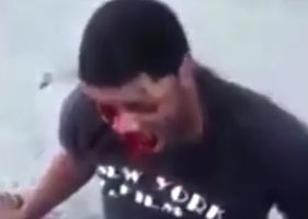 Man has his face crushed and destroyed from being punched during a street fight.