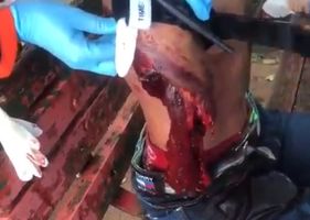 Man has his right arm completely ripped off in an accident.