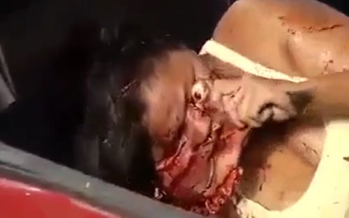 Woman taking off her face as if it were a mask after a traffic accident in Brazil.