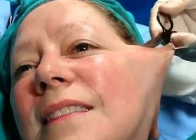 Woman with open face during surgery.