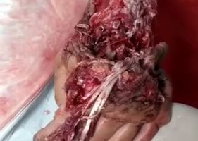 Man moving his hand completely destroyed in accident.