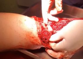 Surgical procedure on fractured arm while doctor explains what to do.