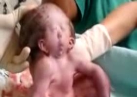 Bizarre baby with two faces.