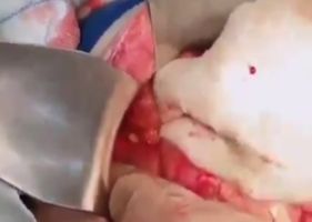 Doctor removing chicken bone that pierced a patient’s intestine.