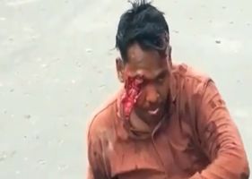 Man loses his eye and part of his face in a motorcycle accident in India.