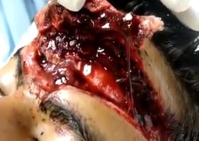 Patient with a wide open forehead due to an accident.