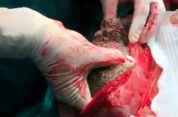 Giant bezoar being surgically removed from a patient's belly Photo 0001 Video Thumb
