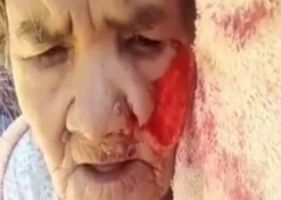Pitbull bites elderly woman on the face.