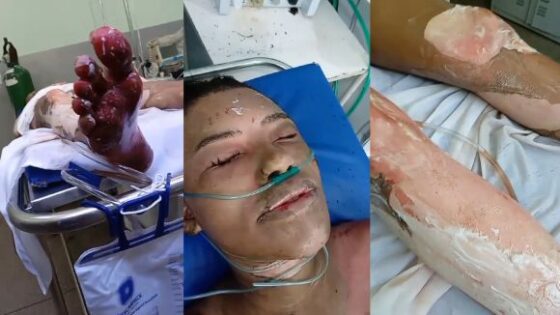 Woman tries to kill herself with self immolation but ends up on a hospital table covered in third degree burns Photo 0001 Video Thumb