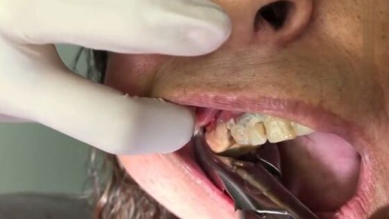 Dentist removing some monster shit from womans mouth Photo 0001 Video Thumb