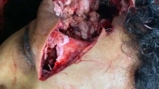 His head opened wide and exposed his brain due to great physical trauma Photo 0001 Video Thumb