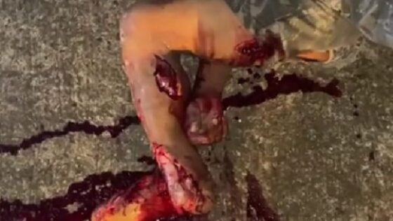 Man has his foot destroyed as a result of traffic accident in brazil Photo 0001 Video Thumb