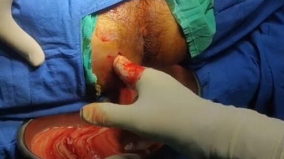 Removing smelly liquid from a sick mans bottom during bizarre surgery perianal abscess drainage Photo 0001 Video Thumb