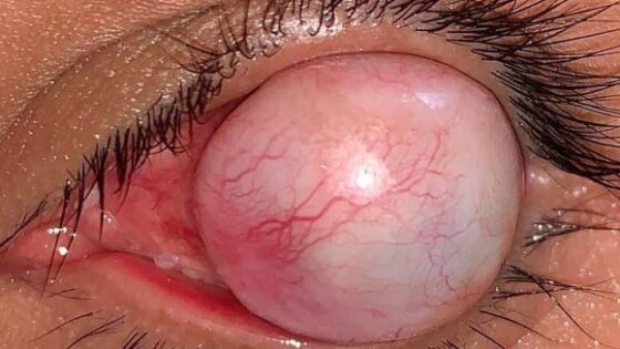 Terrible staphyloma disease Photo 0001 Video Thumb